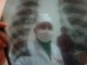 2000 بیمار مبتلا به توبرکلوز درغرب کشور درمان شدند