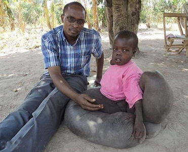 پسری با پاهای فیلی در اوگاندا