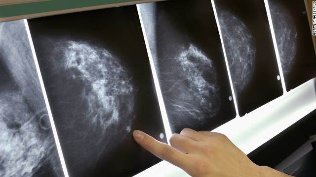 New late-stage breast cancer treatment approved