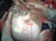 تولد یک نوزاد درون کیسه آب