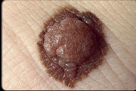 درمان سرطان پوست با تزریق PV10