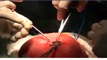 "جراحی باز" نخاع جنین در رحم مادر/فلم