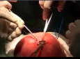 "جراحی باز" نخاع جنین در رحم مادر/فلم  