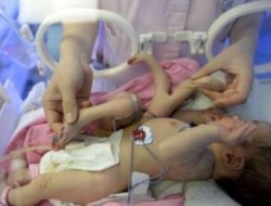 داکتران دست و پای اضافی یک نوزاد ۱۳ روزه را از بدن وی جدا کردند