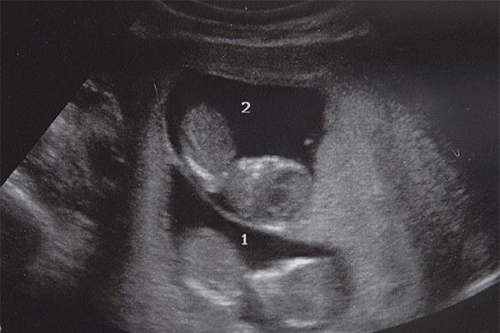 هفته 12 بارداری و قلب هر دو جنین به سلامت می‌تپد