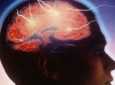 درمان سکته مغزی با استفاده از سلولهای بنیادی