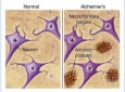 مشاهده نشانه‌های آلزایمر، 50 سال قبل از بروز بیماری