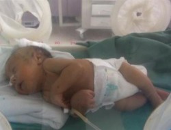 اثرات مخرب جنگ یمن وافزایش نوزادان ناقص الخلقه