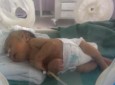 اثرات مخرب جنگ یمن وافزایش نوزادان ناقص الخلقه