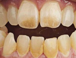 نشانه کمبود ویتامین D در دندان