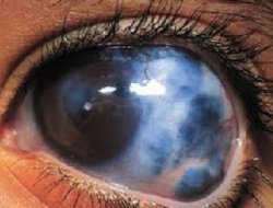 به بیماری آب سیاه چشم بیشتر آشنا شوید / بیش از ۷۰ میلیون نفر در جهان مبتلا به این مرض اند