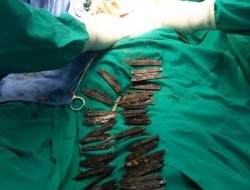 40 چاقوی فلزی بلعیده شده از معده بیمار هندی خارج شد
