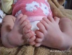 تولد نوزادی با ۳۱ انگشت در چین