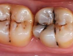 علائم  پوسیدگی دندان در انسان