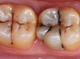علائم  پوسیدگی دندان در انسان