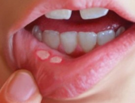 رد پای سرطان در آفت‌های دهانی