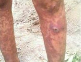 گسترش بیماری های پوستی و تومورهای بدخیم در صعده یمن