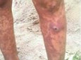 گسترش بیماری های پوستی و تومورهای بدخیم در صعده یمن
