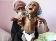 ۴۰۰ هزار کودک یمنی با خطر مرگ مواجه هستند