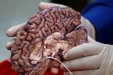 سمی شدن بافت آسیب دیده مغز پس از سکته