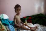 مرگ 141 نفر بر اثر ابتلا به دیفتری در یمن