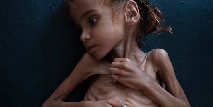دختر خردسال یمنی از گرسنگی جان باخت