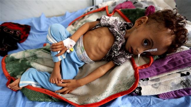 Almost 85,000 Yemeni kids may have died of malnutrition amid Saudi war: Save the Children