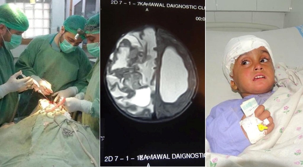 Nangarhar doctors perform successful brain surgery on a 4-year-old girl