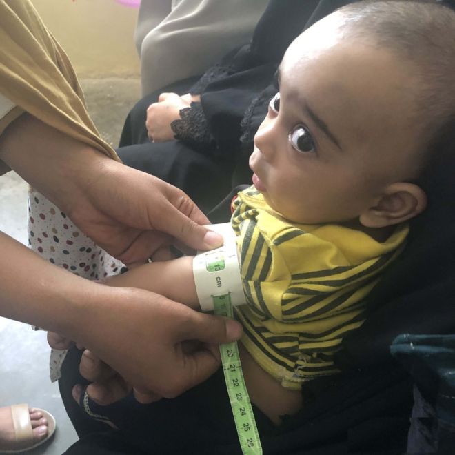 حدود ۲.۵ میلیون کودک و مادر در افغانستان دچار سوء تغذیه هستند