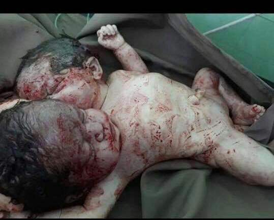 تولد یک نوزاد دو سر در هرات