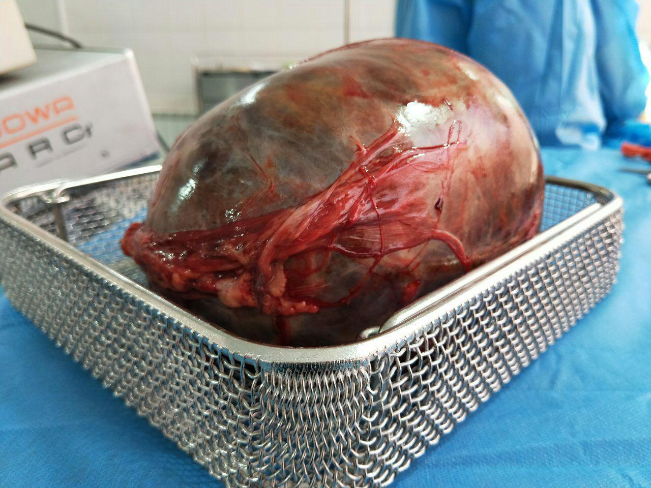 جراحی تومور 4 کیلوگرمی در بطن یک زن در هرات