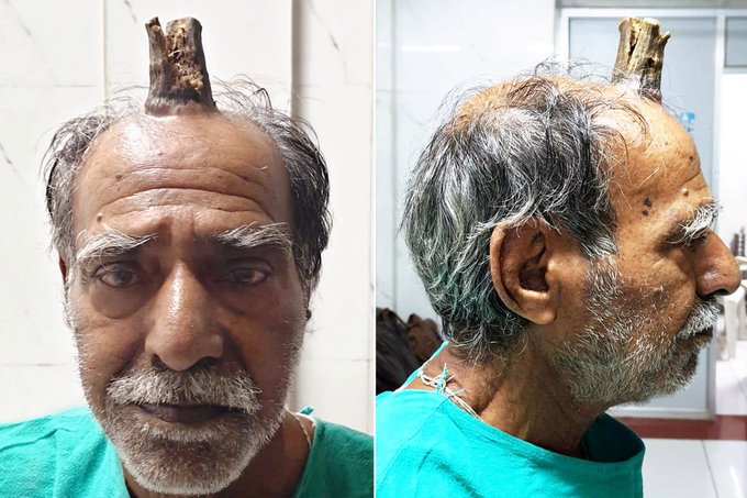 Four-inch ‘devil horn’ removed from man’s head