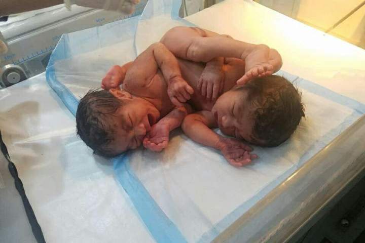 به دنیا آمدن نوزادی به هم چسپیده در هرات