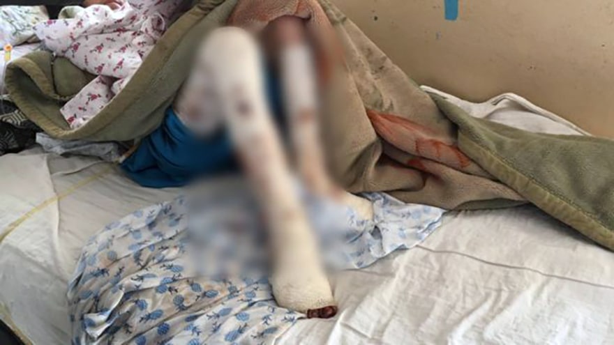 Afghan woman tortured terribly by her husband may lose both legs