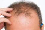 رشد مجدد مو با کمک یک محلول مبتنی بر سلول‌های بنیادی