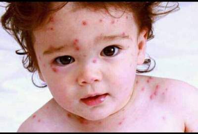 Nearly four thousand children have been infected with measles in Badakhshan