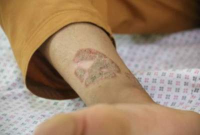 افزایش امراض جلدی میان شهروندان در شهر مزارشریف